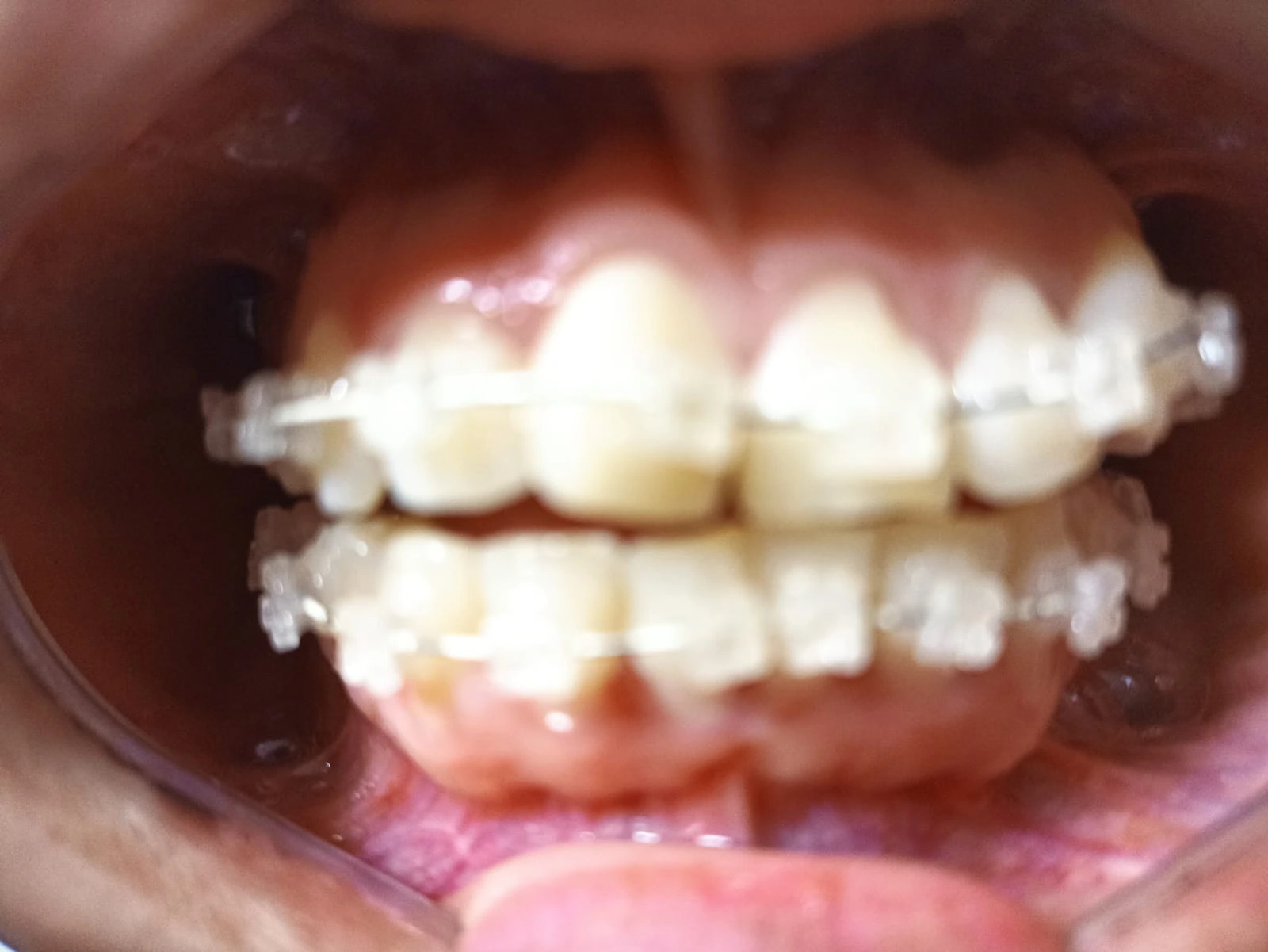 Antes del tratamiento de Karina